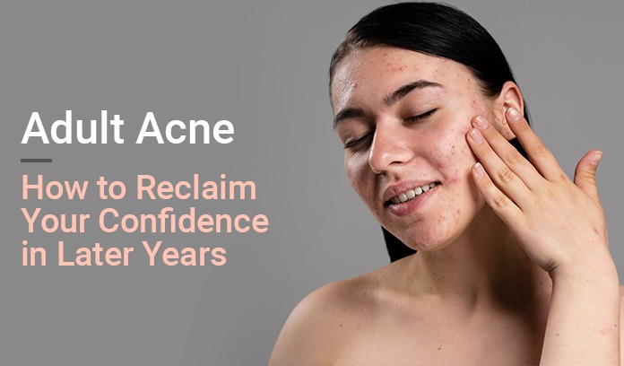 Adult Acne
